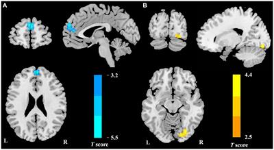 Brain functional connectivity patterns associated with symptoms of vestibular migraine